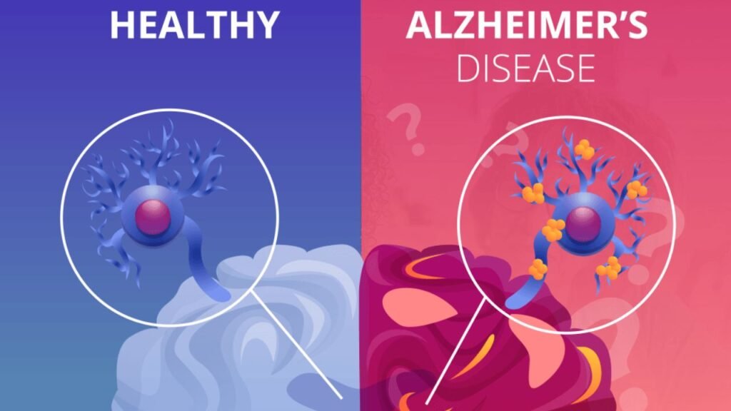 What Causes Alzheimer's Disease? 